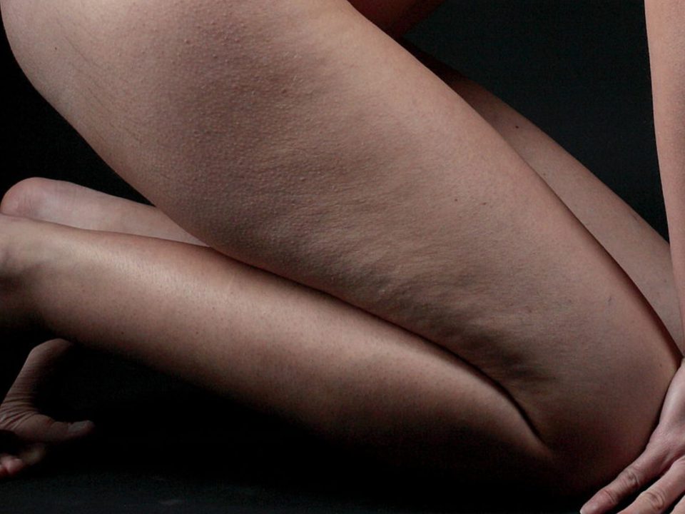 Cellulite: cos’è, come si forma, come si combatte