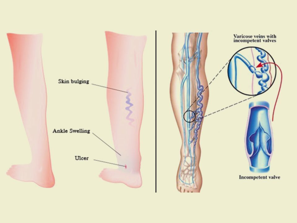 Varici degli arti inferiori